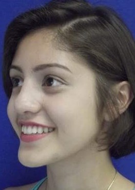 Dr Suzman Rhinoplasty